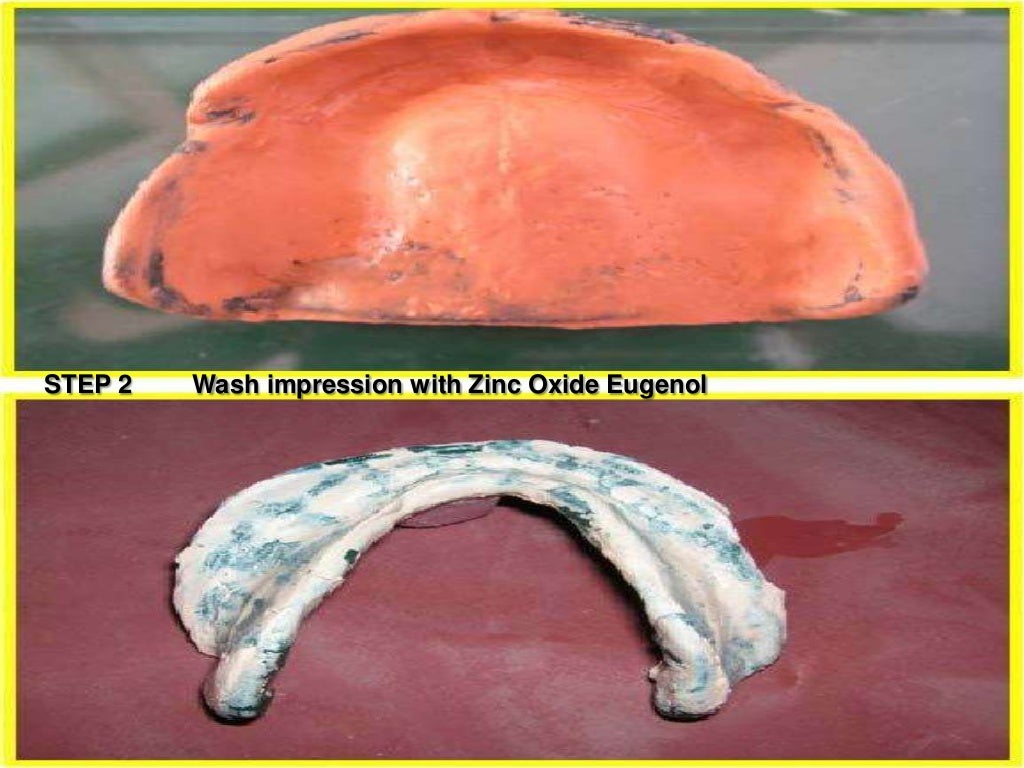 Neutral zone impression technique