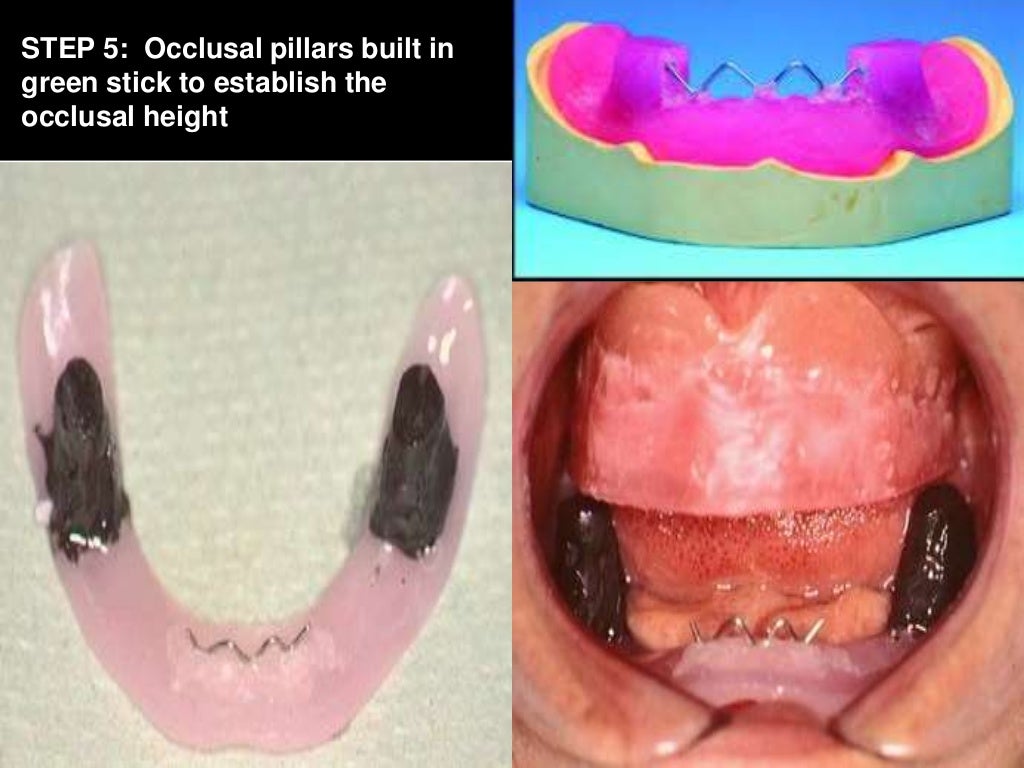 Neutral zone impression technique