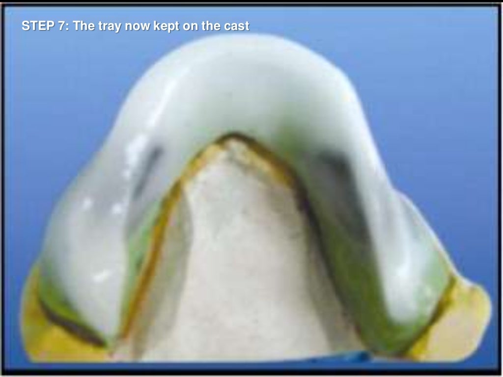 Neutral zone impression technique