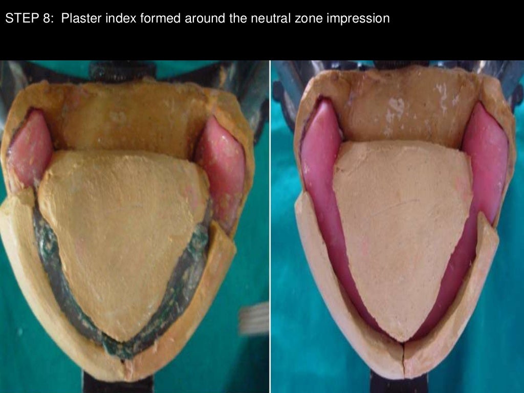 Neutral zone impression technique