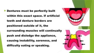  Dentures must be perfectly built
within this exact space. If artificial
teeth and denture borders are
positioned outside of it, the
surrounding muscles will continually
push and dislodge the appliance,
causing instability, soreness, and
difficulty eating or speaking.
 