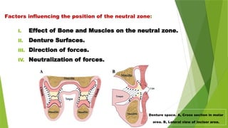 Factors influencing the position of the neutral zone:
I. Effect of Bone and Muscles on the neutral zone.
II. Denture Surfaces.
III. Direction of forces.
IV. Neutralization of forces.
Denture space. A, Cross section in molar
area. B, Lateral view of incisor area.
 