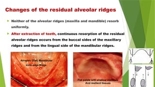 Changes of the residual alveolar ridges
 Neither of the alveolar ridges (maxilla and mandible) resorb
uniformly.
 After extraction of teeth, continuous resorption of the residual
alveolar ridges occurs from the buccal sides of the maxillary
ridges and from the lingual side of the mandibular ridges.
Atrophic (Flat) Mandibular
knife edge Ridge
Flat palate with shallow vestibule
And resilient tissues
 