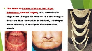  This leads to smaller maxillae and larger
mandibular alveolar ridges; thus, the residual
ridge crest changes its location in a buccolingual
direction after resorption. In addition, the tongue
has a tendency to enlarge in the edentulous
mouth.
 