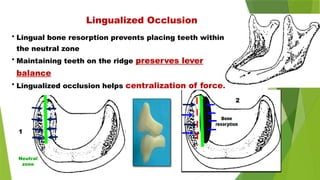 • Lingual bone resorption prevents placing teeth within
the neutral zone
• Maintaining teeth on the ridge preserves lever
balance
• Lingualized occlusion helps centralization of force.
Bone
resorption
Neutral
zone
Lingualized Occlusion
1
2
 