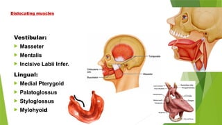 Dislocating muscles
Vestibular:
 Masseter
 Mentalis
 Incisive Labii Infer.
Lingual:
 Medial Pterygoid
 Palatoglossus
 Styloglossus
 Mylohyoid
 
