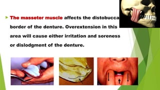  The masseter muscle affects the distobuccal
border of the denture. Overextension in this
area will cause either irritation and soreness
or dislodgment of the denture.
 