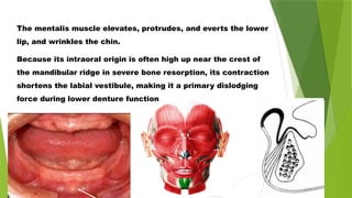 The mentalis muscle elevates, protrudes, and everts the lower
lip, and wrinkles the chin.
Because its intraoral origin is often high up near the crest of
the mandibular ridge in severe bone resorption, its contraction
shortens the labial vestibule, making it a primary dislodging
force during lower denture function
 