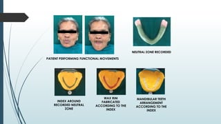 PATIENT PERFORMING FUNCTIONAL MOVEMENTS
NEUTRAL ZONE RECORDED
INDEX AROUND
RECORDED NEUTRAL
ZONE
WAX RIM
FABRICATED
ACCORDING TO THE
INDEX
MANDIBULAR TEETH
ARRANGEMENT
ACCORDING TO THE
INDEX
 