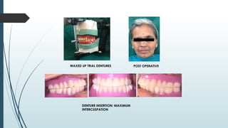 WAXED UP TRIAL DENTURES POST OPERATIVE
DENTURE INSERTION: MAXIMUM
INTERCUSPATION
 