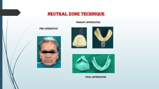 NEUTRAL ZONE TECHNIQUE
PRE-OPERATIVE
PRIMARY IMPRESSIONS
FINAL IMPRESSIONS
 