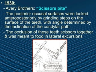 1930: - Avery Brothers:  “ Scissors bite ” - The posterior occusal surfaces were locked anteroposteriorly by grinding steps on the surface of the teeth, with angle determined by the inclination of the condylar path. - The occlusion of these teeth scissors together & was meant to food in lateral excursions  
