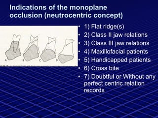 Indications of the monoplane occlusion (neutrocentric concept) 1) Flat ridge(s) 2) Class II jaw relations 3) Class III jaw relations 4) Maxillofacial patients 5) Handicapped patients 6) Cross bite 7) Doubtful or Without any perfect centric relation records 