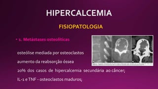 FISIOPATOLOGIA
• 1. Metástases osteolíticas
 