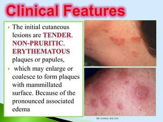 Neutropeic Rash Neutrophilic dermatosis | PPSX