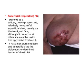 • Superficial (vegetative) PG:
• presents as a
solitary,slowly progressing,
relatively non-painful
superficial ulcer, usually on
the trunk,and face,
although it can occur at
other sites,resolves with
less aggressive treatment.
• It has a non-purulent base
and generally lacks the
violaceous,undermined
border of classic PG.
 