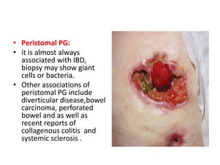 • Peristomal PG:
• it is almost always
associated with IBD,
biopsy may show giant
cells or bacteria.
• Other associations of
peristomal PG include
diverticular disease,bowel
carcinoma, perforated
bowel and as well as
recent reports of
collagenous colitis and
systemic sclerosis .
 