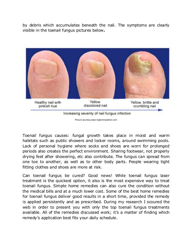 Never Before Seen Toenail Fungus Remedy