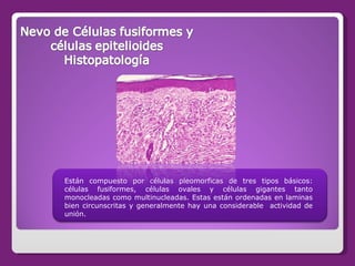 Están compuesto por células pleomorficas de tres tipos básicos: células fusiformes, células ovales y células gigantes tant...