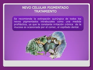 Se recomienda la extirpación quirúrgica de todos los nevos pigmentados intrabucales como una medida profiláctica, ya que l...