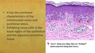 Nevus Layer Nevus | PPTX