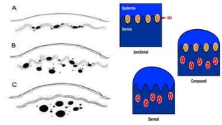 Nevus Layer Nevus | PPTX
