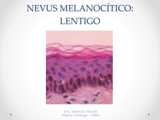 NEVUS MELANOCÍTICO:
LENTIGO
 