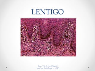 LENTIGO
 