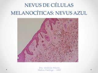 NEVUS DE CÉLULAS
MELANOCÍTICAS: NEVUS AZUL
 