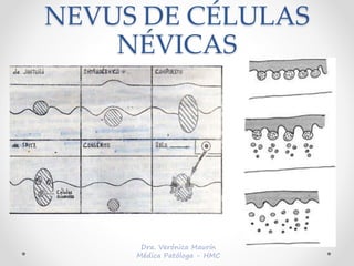 NEVUS DE CÉLULAS
NÉVICAS
 