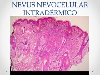 NEVUS NEVOCELULAR
INTRADÉRMICO
 