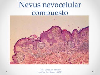 Nevus nevocelular
compuesto
 