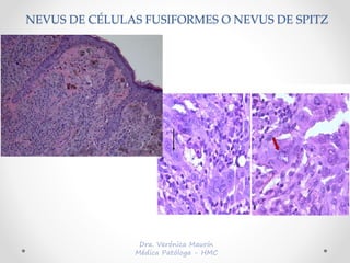 NEVUS DE CÉLULAS FUSIFORMES O NEVUS DE SPITZ
 