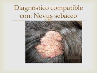 
Diagnóstico compatible
con: Nevus sebáceo
 