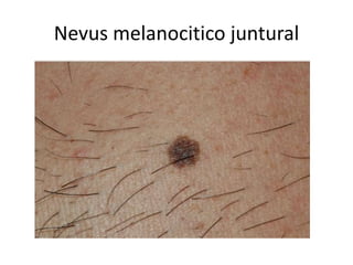 Nevus melanocitico juntural
 