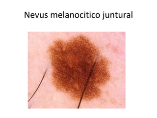Nevus melanocitico juntural
 