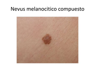 Nevus melanocitico compuesto
 