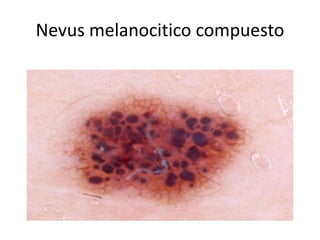 Nevus melanocitico compuesto
 