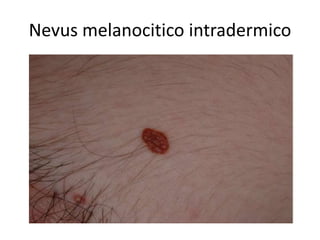 Nevus melanocitico intradermico
 