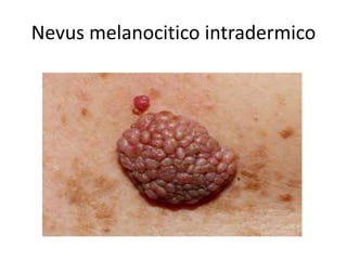 Nevus melanocitico intradermico
 
