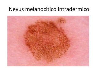 Nevus melanocitico intradermico
 