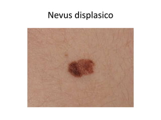 Nevus displasico
 