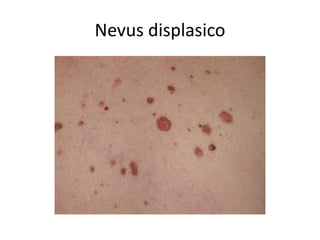 Nevus displasico
 