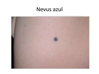 Nevus azul
 