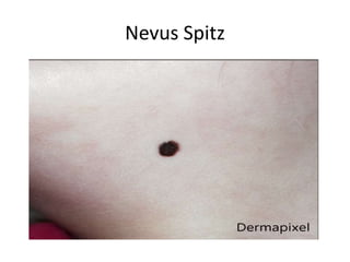 Nevus Spitz
 