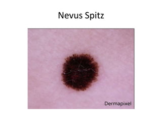 Nevus Spitz
 
