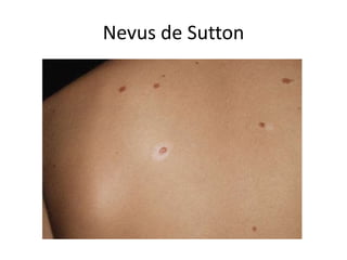 Nevus de Sutton
 