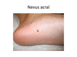 Nevus acral
 