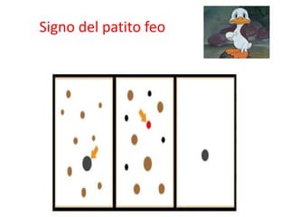 Signo del patito feo
 