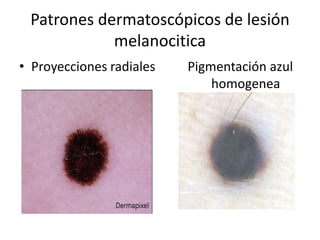 Patrones dermatoscópicos de lesión
melanocitica
• Proyecciones radiales Pigmentación azul
homogenea
 